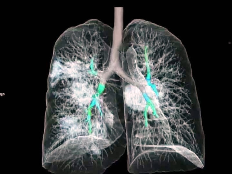 Health lungs